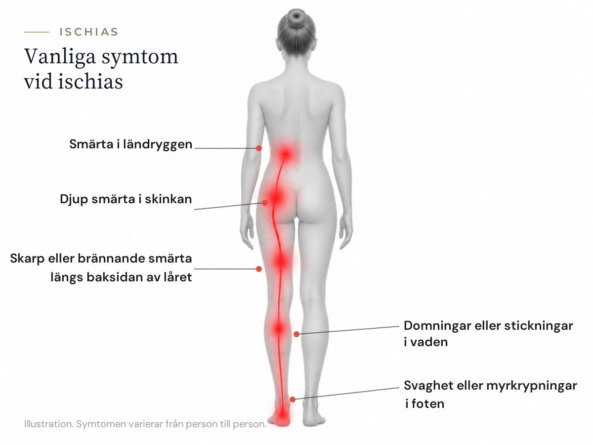 Diagram över symtom vid kronisk ischias
